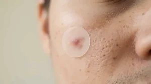 Close-up of hydrocolloid pimple patches used as an effective whitehead treatment on skin.